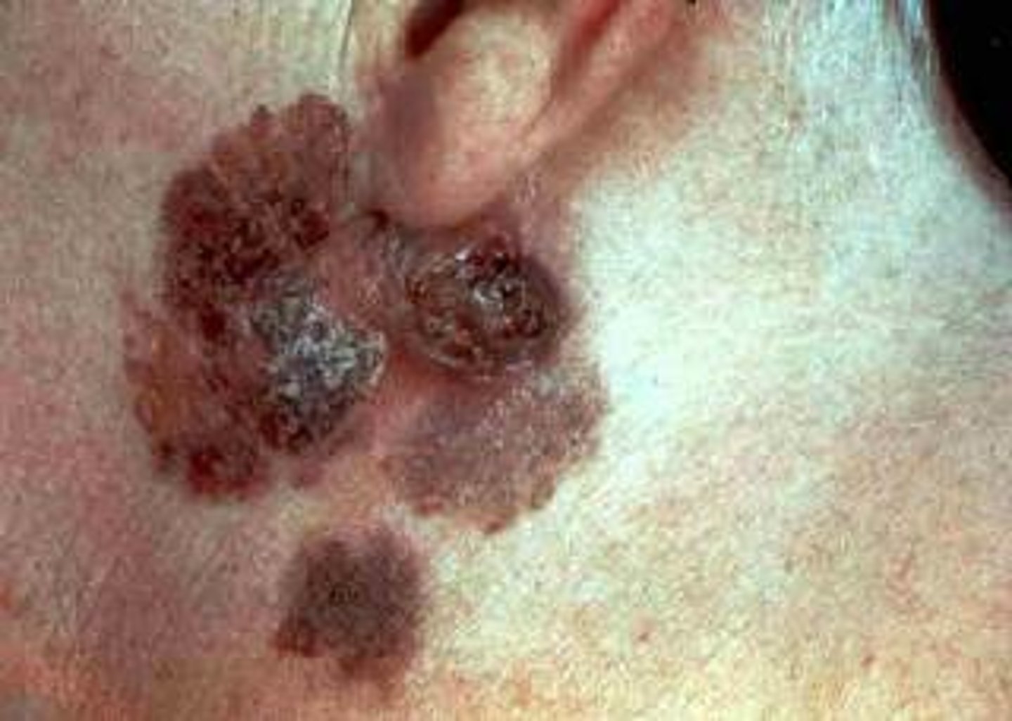 <p>A most serious form of skin cancer; often characterized by black or dark brown patches on the skin that may appear uneven in texture, jagged, or raised.</p>