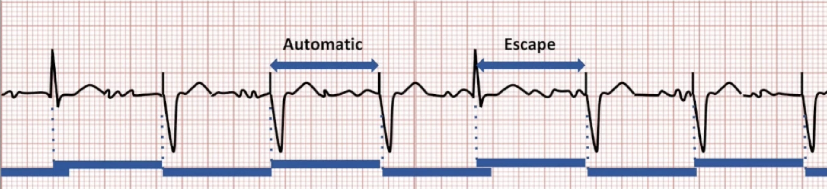 <ul><li><p>Automatic interval triggered by paced beat</p></li><li><p>Escape interval triggered by sensed beat</p></li><li><p>Can be programmed separately with rate hysteresis</p></li></ul><p></p>
