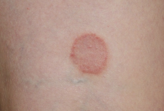 <ul><li><p>Circular</p></li><li><p>Ex: ringworm</p></li></ul><p></p>
