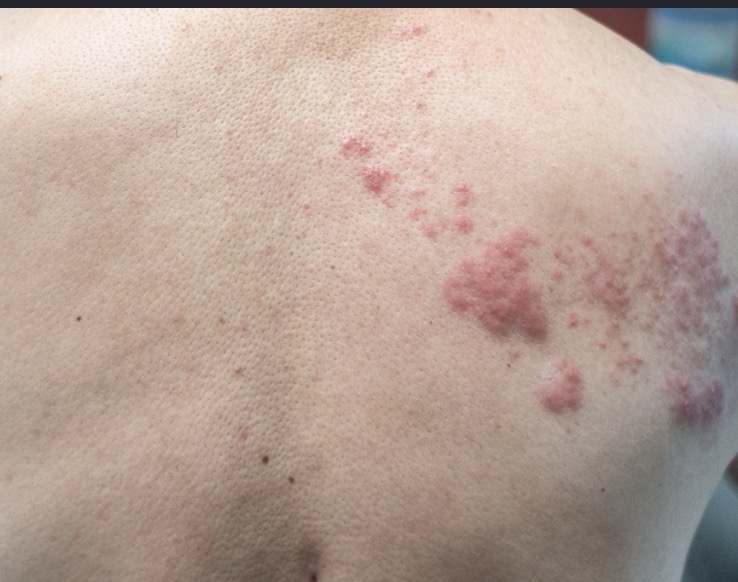 <ul><li><p>linear along a nerve route</p></li><li><p>Ex: herpes zoster (shingles)</p></li></ul><p></p>