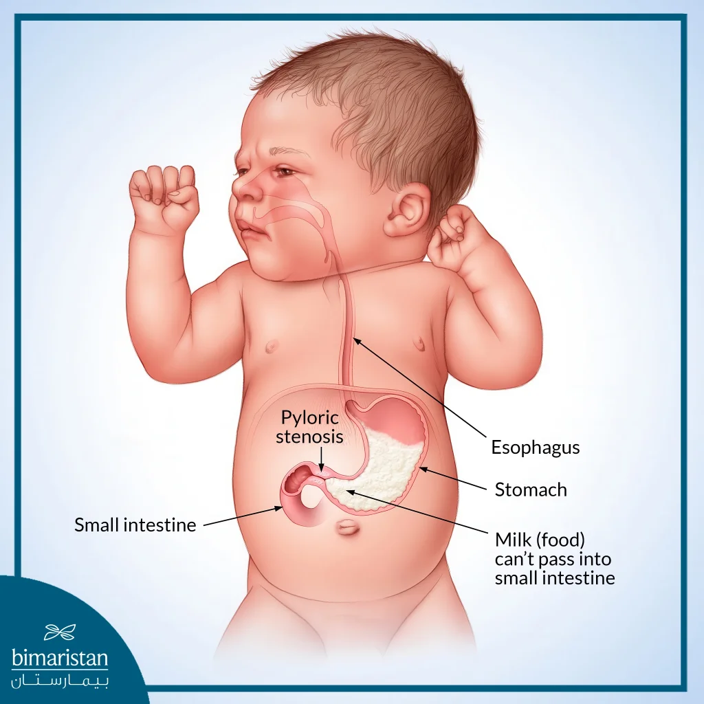 <p>A condition in infants where the pylorus, the opening from the stomach to the small intestine, is narrowed, causing projectile vomiting and dehydration. It typically requires surgical intervention to correct. </p>