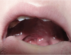 <p>Why is this VPI surgery unsuccessful?</p>