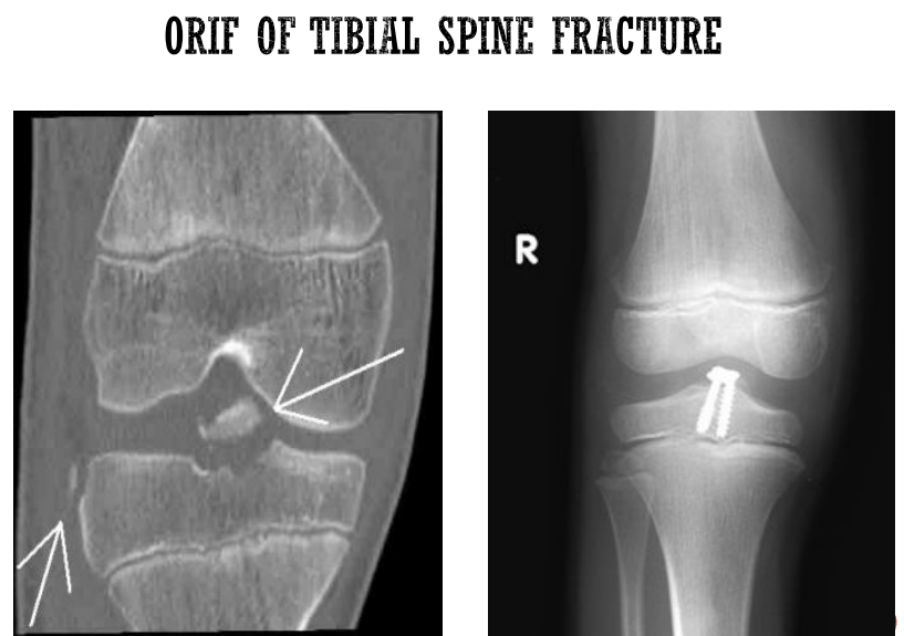 <ul><li><p>Affected leg:</p><ul><li><p>isometric + co-contractions of muscles around knee joint</p></li><li><p>ROM + muscle power around hip + ankle joints</p></li><li><p>bed mobility exercises</p></li><li><p>maintain/improve ROM/muscle power of unaffected limbs</p></li><li><p>removal of POP → regain ROM/MP of knee joint</p></li></ul></li></ul><p></p>