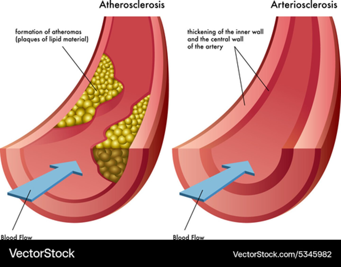 <p>B) Atherosclerosis involves plaque buildup that obstructs blood flow, while arteriosclerosis refers to the hardening of arteries.</p>