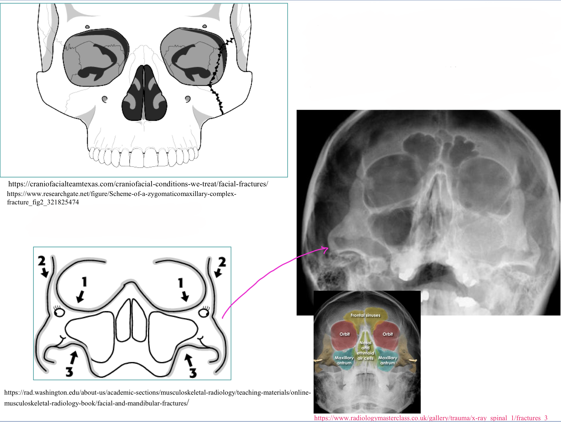 <p>What type of skull fracture is this</p>