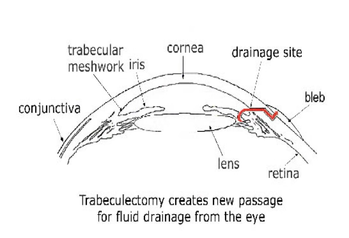 <p>Trabeculectomy</p><ul><li><p>Surgical procedure used to treat glaucoma </p></li><li><p>Removes part of the trabecular meshwork and adjacent tissue </p></li><li><p>Creates a new drainage pathway for aqueous humor </p></li><li><p>Reduces elevated intraocular pressure (IOP) </p></li></ul><p></p>