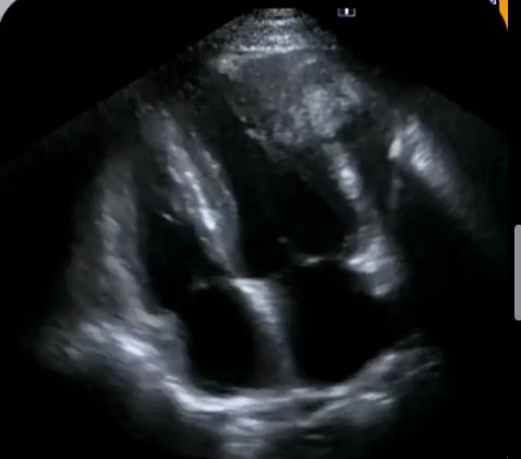 <p>What is cardiac fibroma?</p>