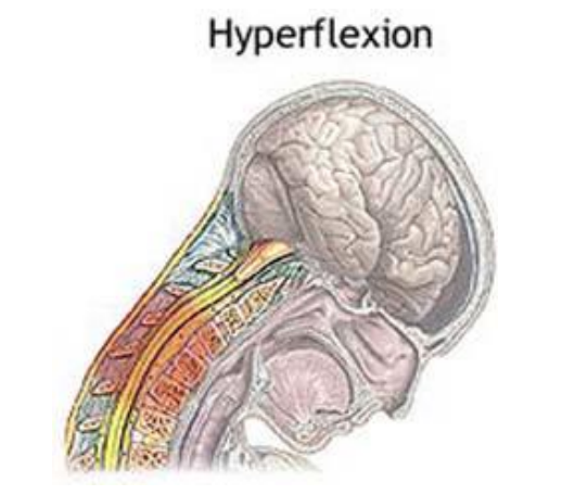 <p>posterior longitudinal ligament (would tear if stretched to far)</p>