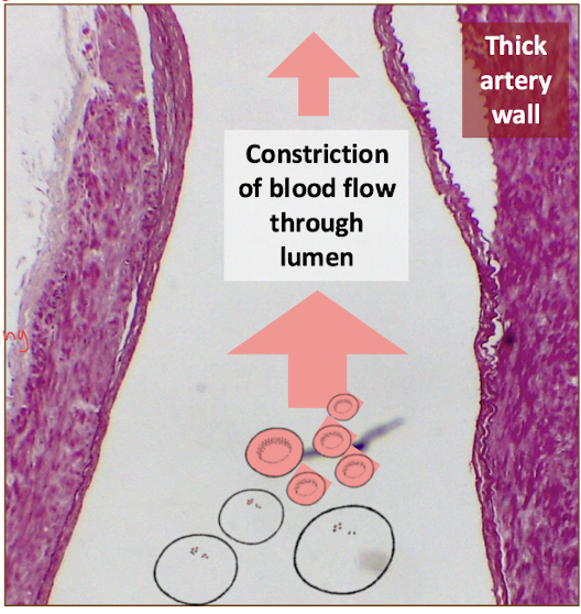 <p>constriction of blood flow through lumen</p>