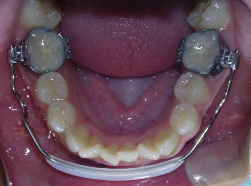 <p>Lip Bumper</p>