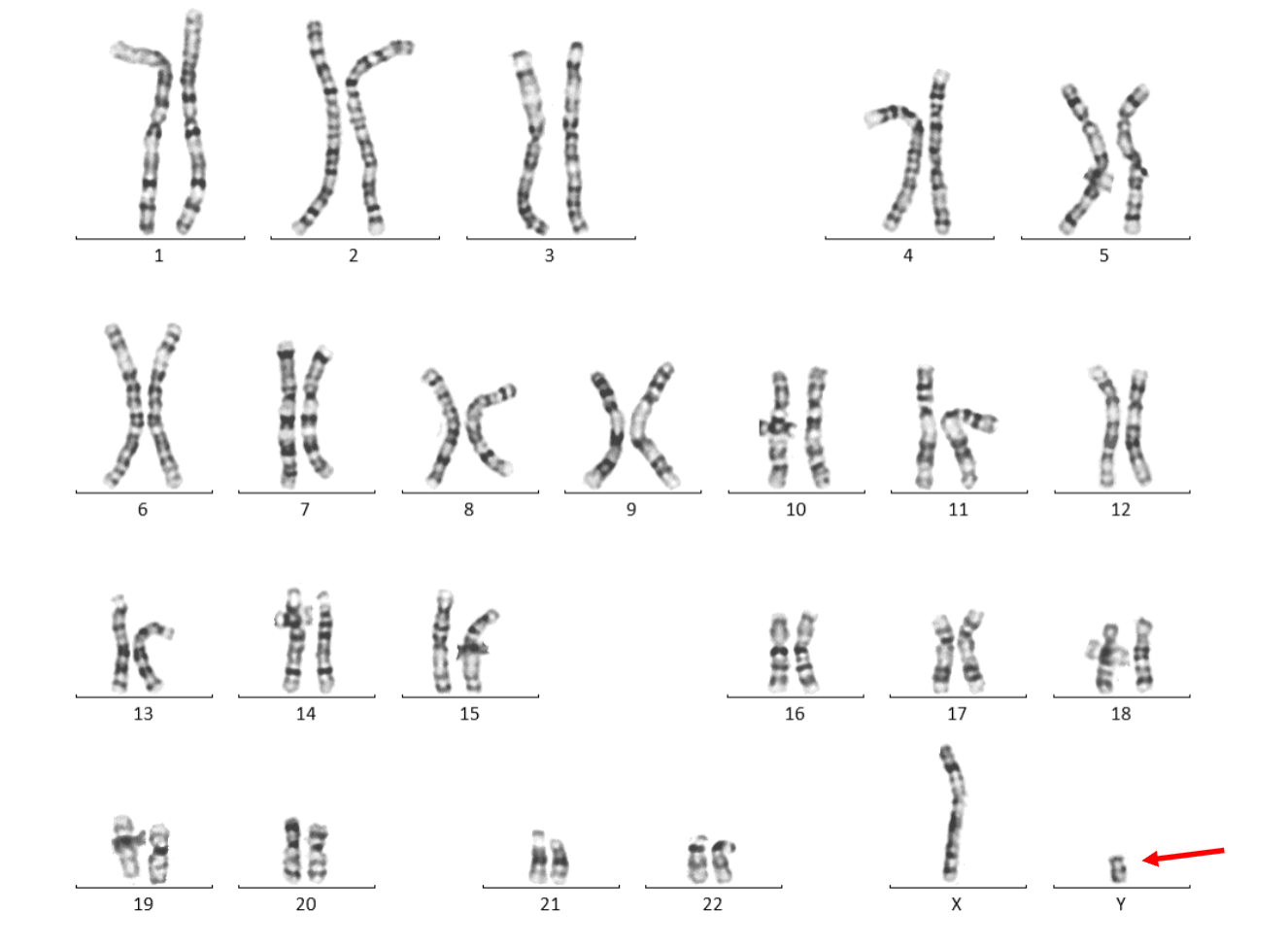 <p>Male, 27 y</p><p>Clinical indication: INFERTILITY</p><ul><li><p>What is the only thing we can tell from this karyotype? </p></li></ul><p></p>