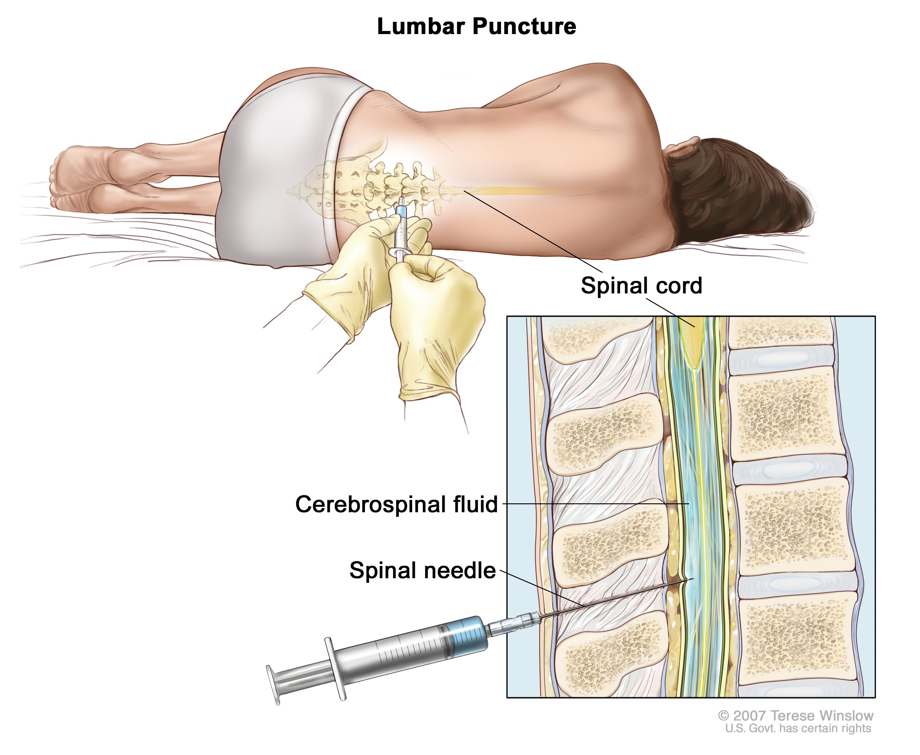 <p>Meninge - <strong>Lumbar Puncture</strong> ( _____ tap)</p><p>remove ____ from the _______ space of the lumbar cistern?</p>