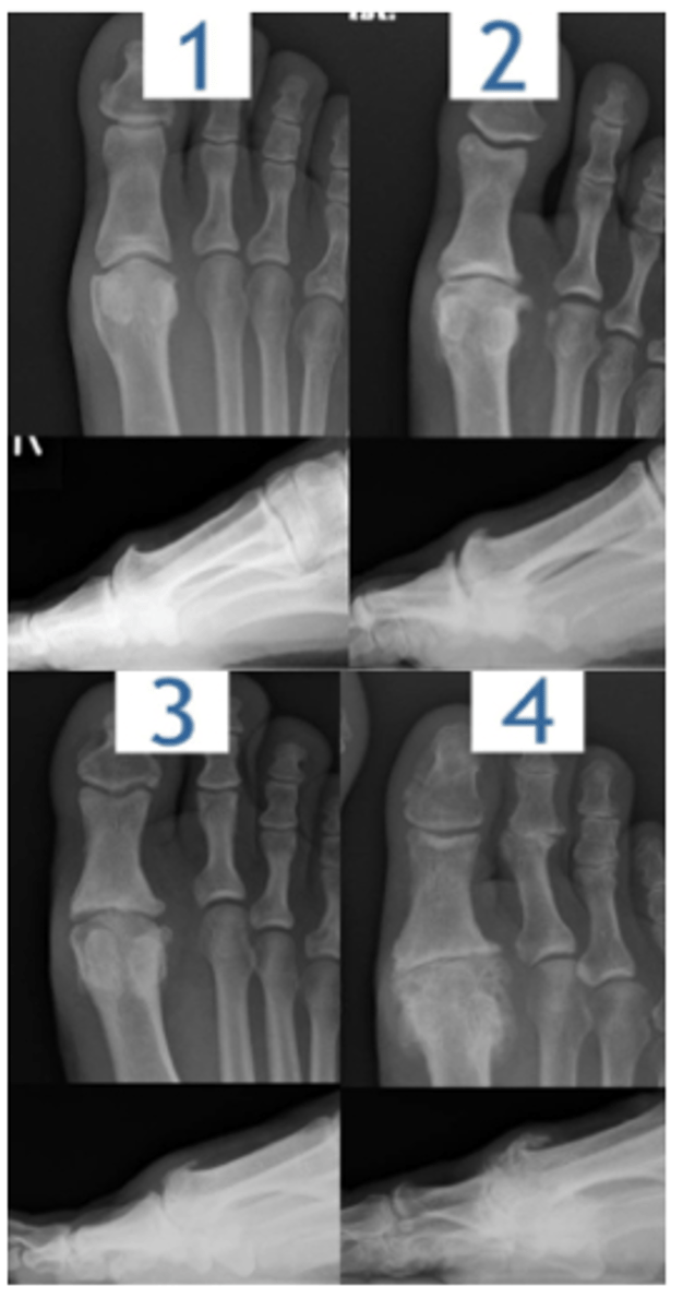<p>MPJ Joint Degeneration</p><p>Stage I: "Functional limitus" - MPJ unable to fully dorsiflex</p><p>during gait. NO radiographic changes yet.</p><p>Stage II: "Joint Adaptation" - small dorsal exostosis and</p><p>met head flattening. Pain at end ROM.</p><p>Stage III: Asymmetric joint space narrowing, large dorsal</p><p>spurring, severe met head flattening. Pain and crepitus w</p><p>full ROM, OA well established now.</p><p>Stage IV: Anklyosis of joint. Severe osteophytes and joint</p><p>mice present. Pain usually from skin irritation due to</p><p>friction from rubbing over large osteophytes. Less pain</p><p>from ROM at this stage as joint has no motion.</p>