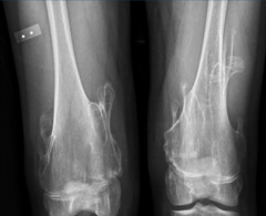 <p>What is this?</p><p>- < 20 yo, Male</p><p>- No pain</p><p>- Short ulna/ Bowing radius/ Sublux radioulnar jt</p>