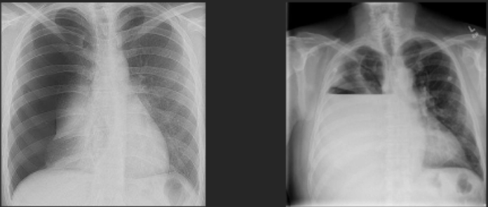 <p><span>what are the lung pathology for L and R?</span></p>
