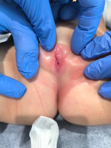 <p>Fusión o adherencia de los labios menores de la vulva.</p>