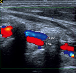 <p>Based on this image, which vessel is being shown?</p>