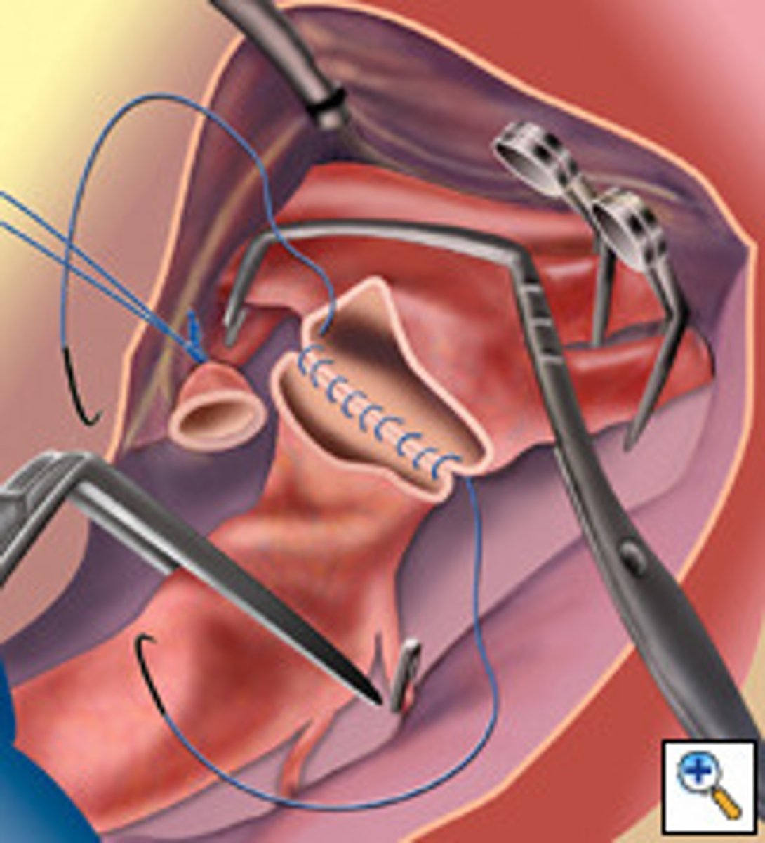 <p>anastomosis</p>