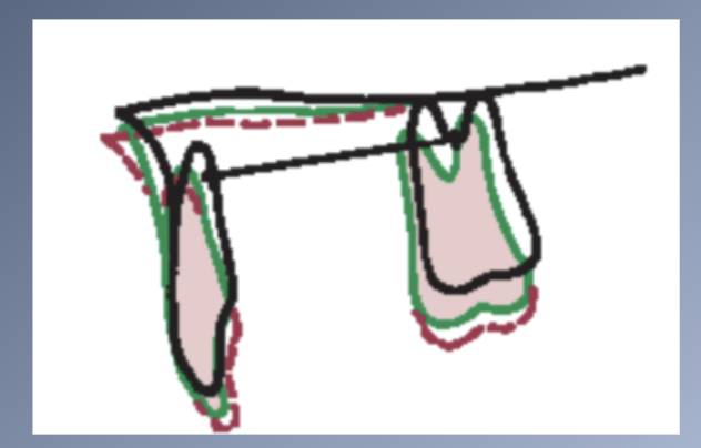 <p><span>Vertical and anteroposterior positions of the incisors are affected</span><br><span>1. SHORT FACE:</span><br><span>1. Excessive rotation à incisors are carried into an overlapping position à tendency for deep bite malocclusions.</span><br><span>2. Uprighting of incisors produces tendency toward crowding.</span></p><p><span>LONG FACE:</span><br><span>1. increase Anterior face height à open bite; unless incisors erupt for an extreme distance.</span><br><span>2. Rotation of the jaws carries the incisors forward à dental protrusion</span></p>