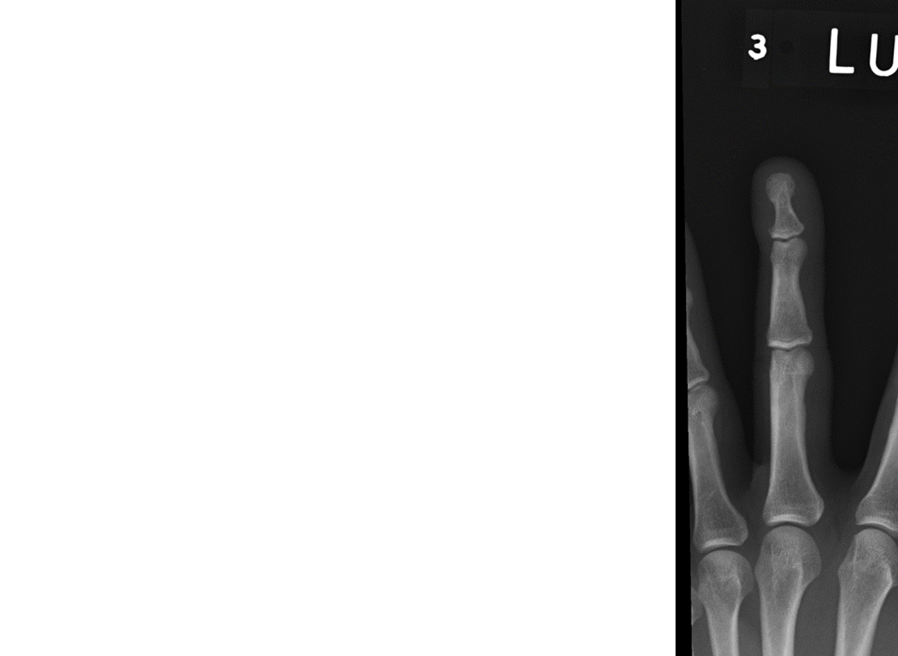 <p>What projection is this finger x-ray?</p>