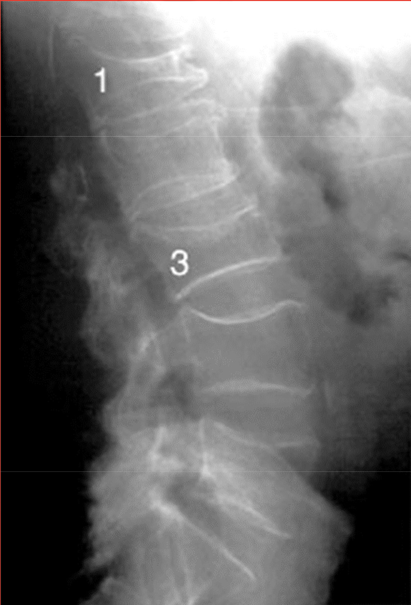 <p>What type of fracture due to osteoporosis is shown in the image</p>
