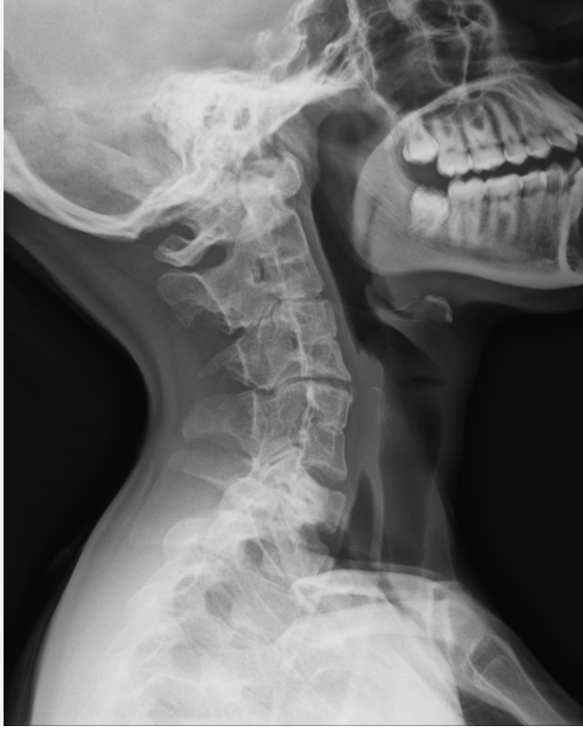 <p>Multiple congenital blocks, associated with sprengle’s deformity and omovertebral bone </p>