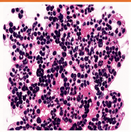 <ul><li><p>diffuse endo en extra cap hypercell</p></li><li><p>neutrofielen en soms exudaten</p></li><li><p>karyorrhexis en fibrinoide necrose mogelijk</p></li><li><p>nefritisch sd → hematurie, proteinurie, hypertensie, nierfunctiestoornis</p></li><li><p>oorzaak → postinfec, SLE, vasculitis </p></li></ul><p></p>