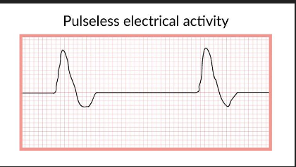 <p>There is no pulse despite electrical activity in the heart, most likely due to muscle death or weakness. Commonly caused by hypovolemia, cardiac tamponade, and hypoxia.</p><p></p><p>NOT shockable, electrical activity is present, AED doesn’t help</p><p></p><p>*Note that a PEA may have different rhythms than the picture</p>