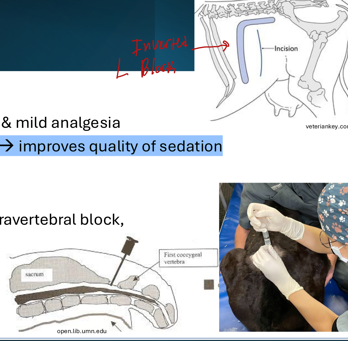 <ol><li><p>Paravertebral block</p></li><li><p><strong>Inverted L block</strong></p></li><li><p>Line Block</p></li></ol><p></p>
