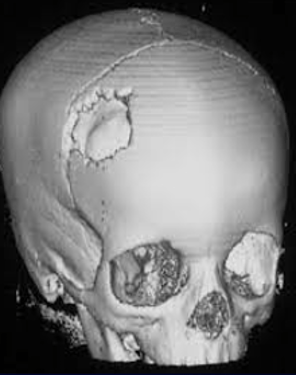<p>D. Depressed fracture</p>