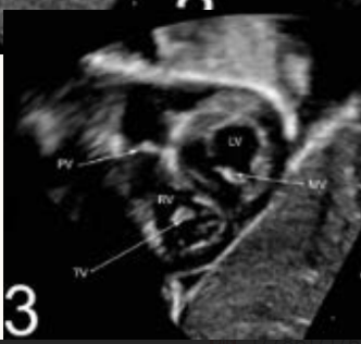 <p>subcostal SAX at ventricle level</p>
