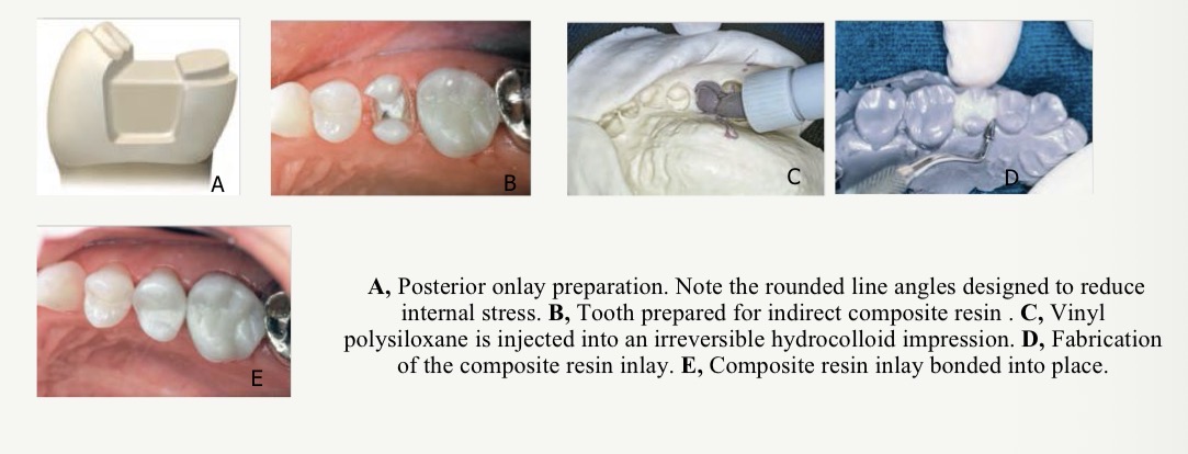 <p>Prep same as direct/indirect technique</p><p>Make an irreversible hydrocolloid impression to see margins of prep </p><p>Inject a firm setting vinyl polysiloxane impression material into the alginate to form a flexible cast </p><p>Fabricate inlay using light cured hybrid composite resin </p><p>Heat treat resto and place </p>