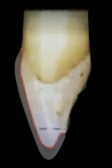 <p>What kind of incisal reduction is this</p>