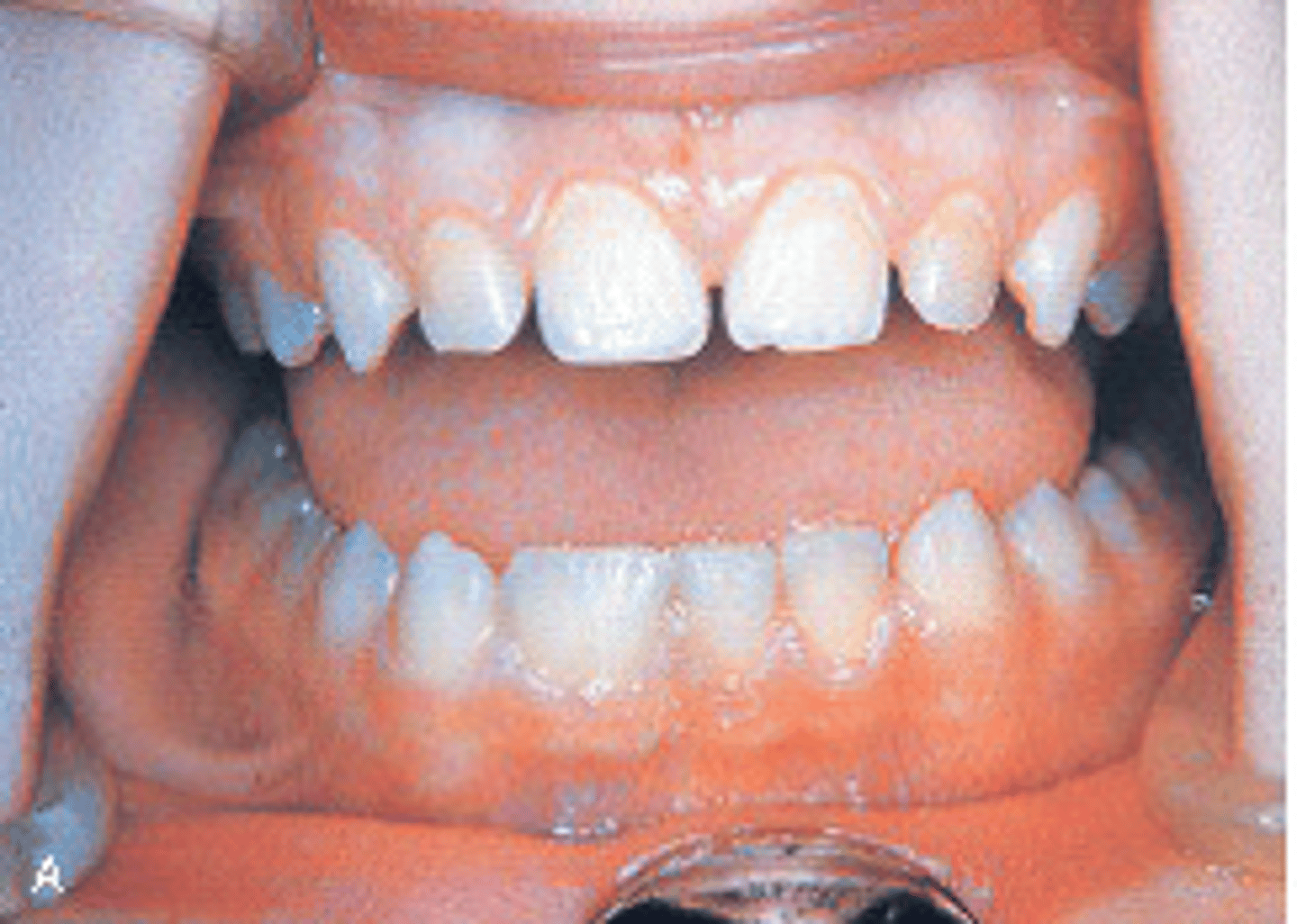 <p>Two roots, one crown on MND lateral incisors (in this picture- usually two roots, two heads, 2 pulps)</p><p><span>When the large tooth in the mandibular arch is counted as one, then there's one less tooth than normal in the mandibular dentition.What condition do you suspect?</span></p>