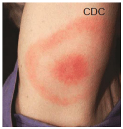 <p>What is this skin rash called?</p>