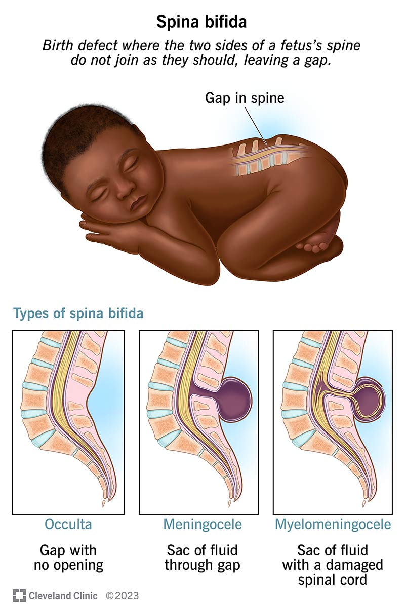 <p>Spina bifida</p>