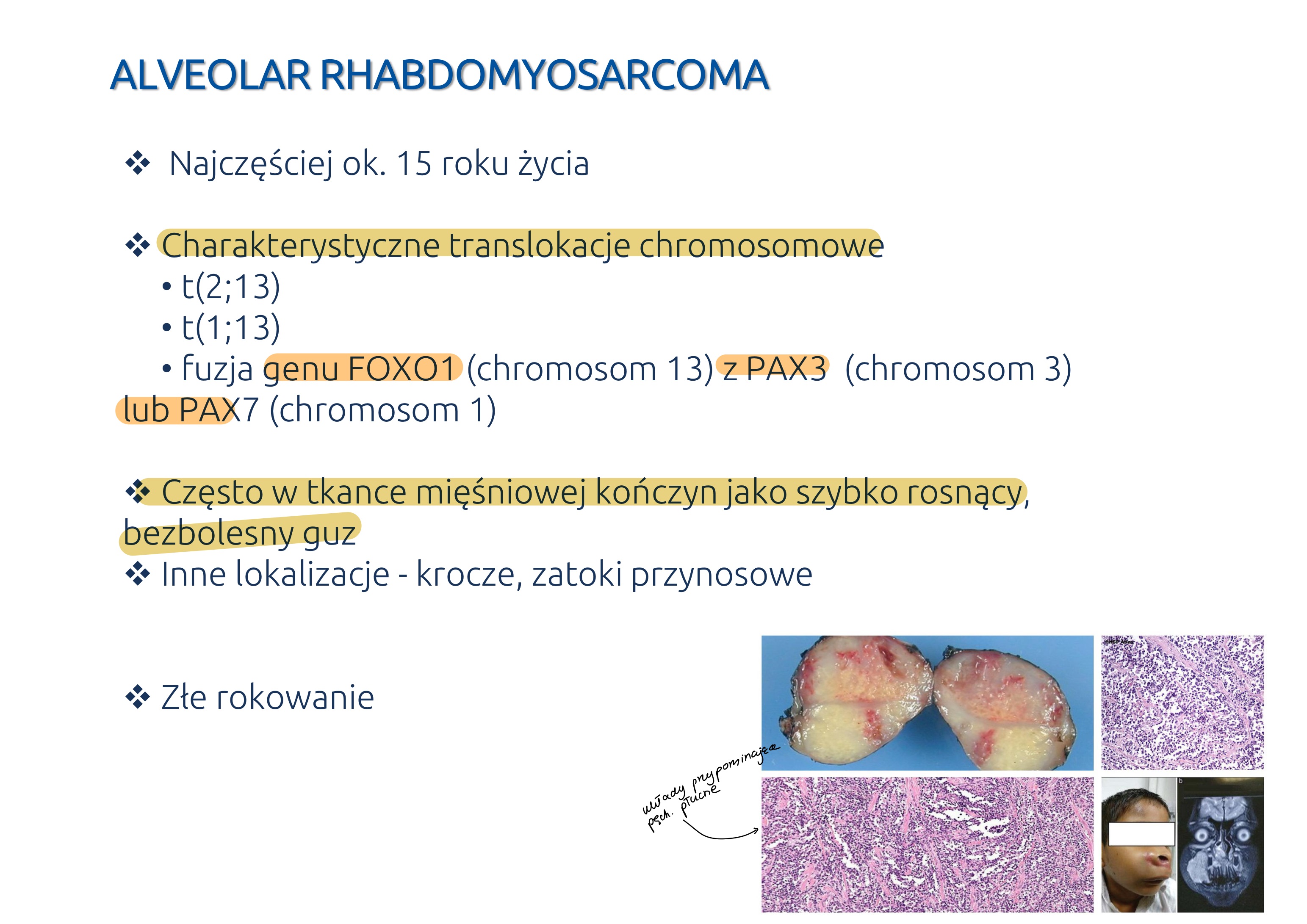 <p>MORFOLOGIA</p><ul><li><p>szerokie łącznotkankowe przegrody, które oddzielają agregaty i gniazda komórek nowotworowych lub tworzą ukłądy na kształt pęcherzyków płucnych</p></li><li><p>komórki okrągłe, zbliżona wielkość, podobny kształt i znikoma kohezja</p></li></ul><p></p>