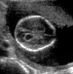 <p>Small cysts in the choroid plexus, caused by trapped CSF. The choroid plexus is a tissue found in each ventricle of the brain that produces cerebrospinal fluid. Often sporadic but is associated with T18</p>