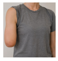 <p>this image shows a major UE unilateral right transhumeral amputation</p><p>t or f</p>