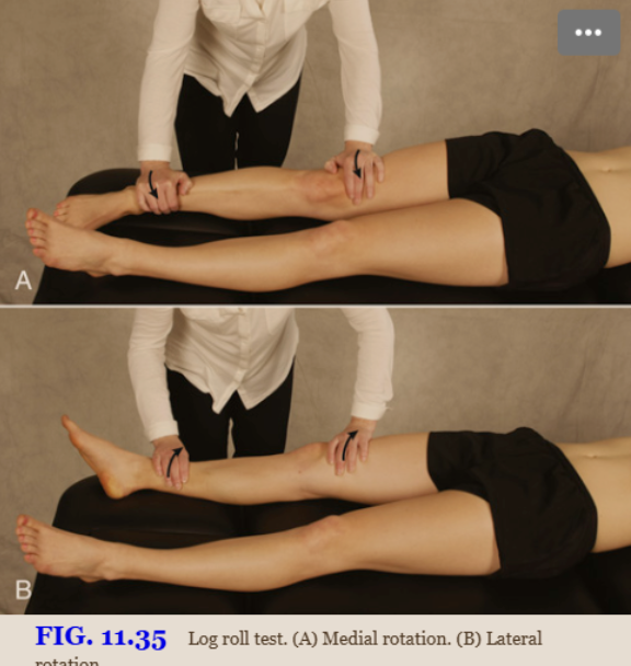 <p><strong>Log Roll (Passive Supine Rotation) Test</strong></p><ul><li><p><strong>How:</strong> Patient supine with both legs extended. Passively <strong>rotate the femur medially and laterally</strong> to end range and compare both hips.</p></li><li><p><span style="background-color: transparent;">If rotational mobility is restricted or painful, → intra-articular hip joint pathology.</span></p></li><li><p><span style="background-color: transparent;">- A “click” during test → a labral tear (intra-articular) increased lateral rotation → a lax iliofemoral ligament</span></p></li></ul><p></p>