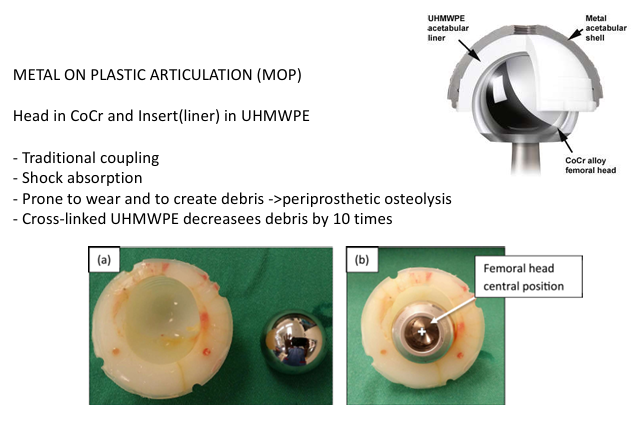<p>METAL ON PLASTIC ARTICULATION (MOP) </p><ul><li><p>Head in CoCr and Insert(liner) in UHMWPE</p></li><li><p>Traditional coupling</p></li><li><p>Shock absorption</p></li><li><p>Prone to wear and to create debris ->periprosthetic osteolysis</p></li><li><p>Cross-linked UHMWPE decreasees debris by 10 time</p></li></ul><p></p>