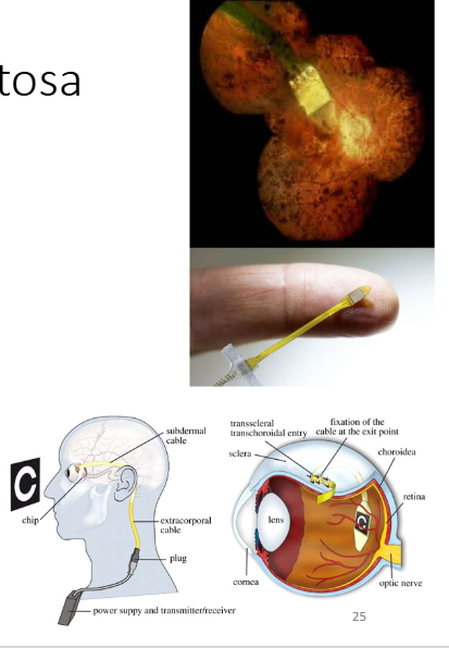<p>Retinitis Pigmentosa</p>