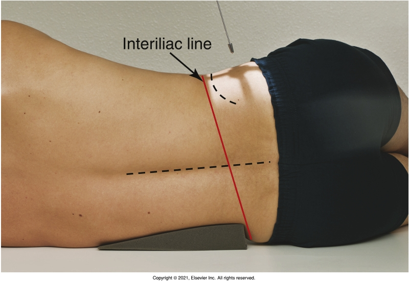 <p>caudal 5° to be parallel to the interiliac line </p>
