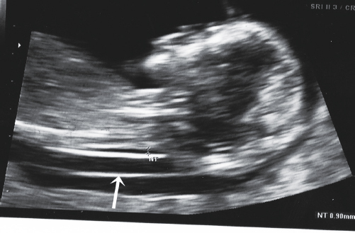 <p>8. What does the arrow in Figure 23-31 indicate?</p><p></p><p>a. Chorionic cavity</p><p>b. Thickened NT</p><p>c. Amnion</p><p>d. Yolk sac</p><p></p>