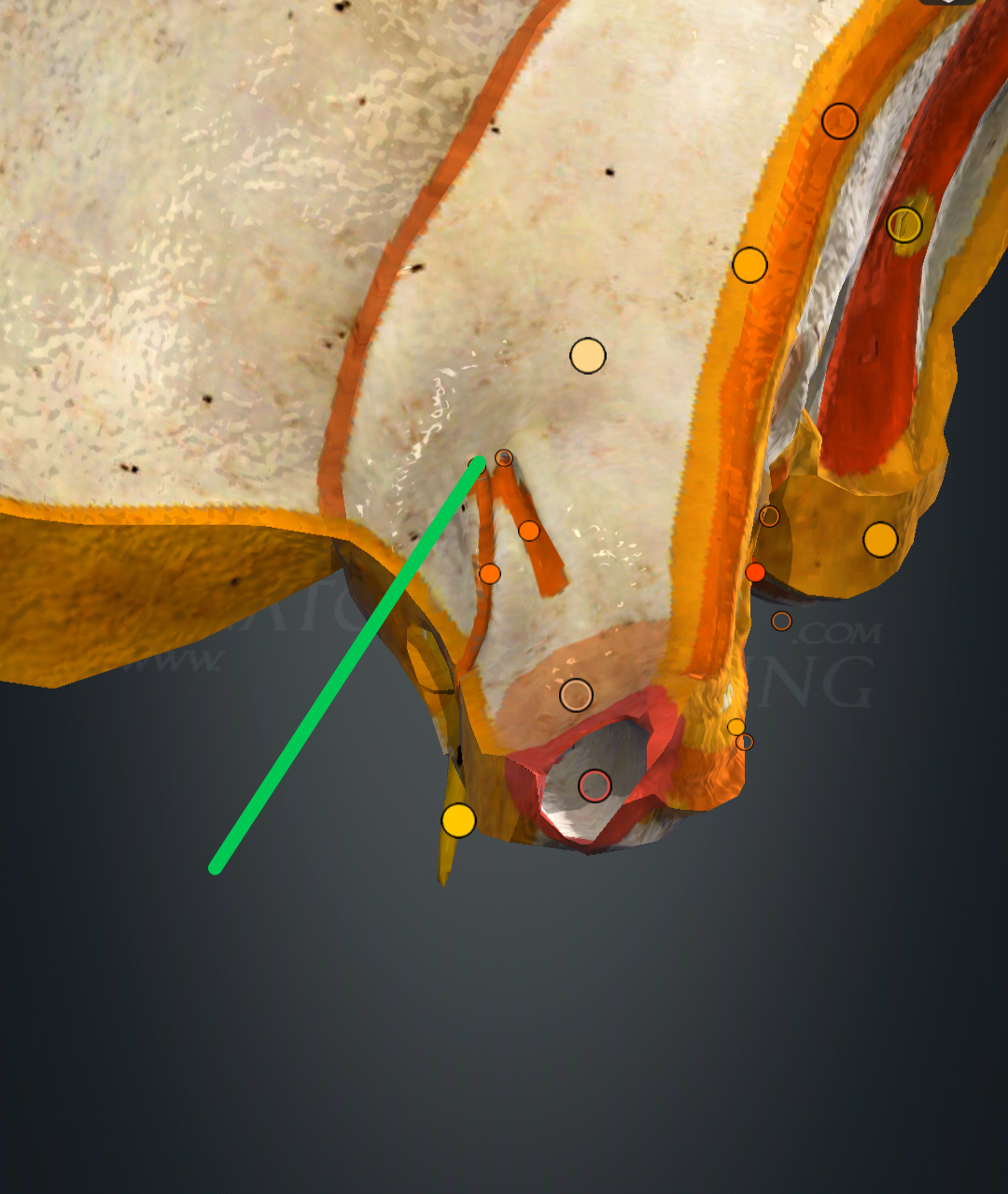 <p>hiatus canalis nervi petrosi minoris</p>