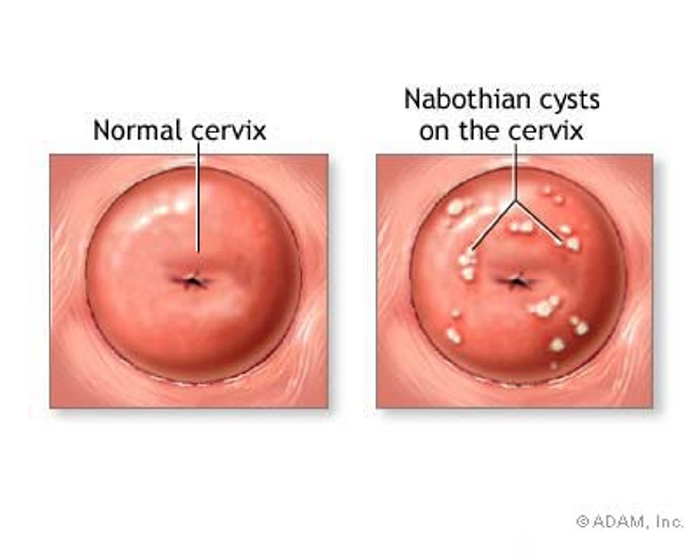 <p>- cysts usually appear translucent or yellow and may vary in diameter from a few mm to several cm.</p><p>- usually nonpainful</p><p>- occur after minor trauma or childbirth</p><p>- asymptomatic cysts do not require treatment- painful=ablation</p>