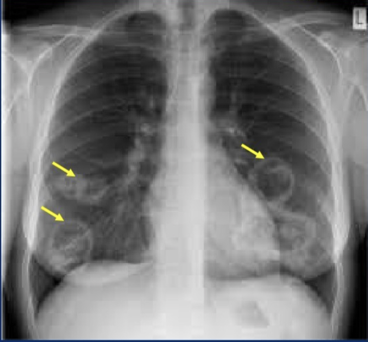 <p>Multiple granulomas coalesce → radiographically visible nodules that can cavitate; late stage = extensive necrotizing granulomatous involvement of parenchyma</p>