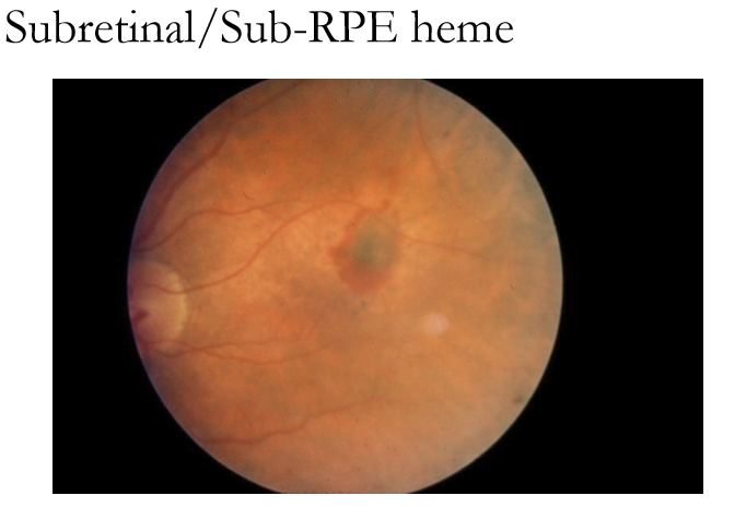 <ul><li><p>Sub‑RPE heme: Gray‑green or dark appearance (blood under RPE pigment).</p></li><li><p>Subretinal heme: Dark red, sitting above the RPE where color is more visible.</p></li></ul><p></p>
