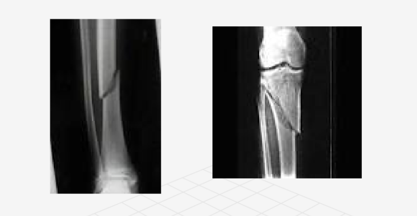 <p>what type of fracture</p>