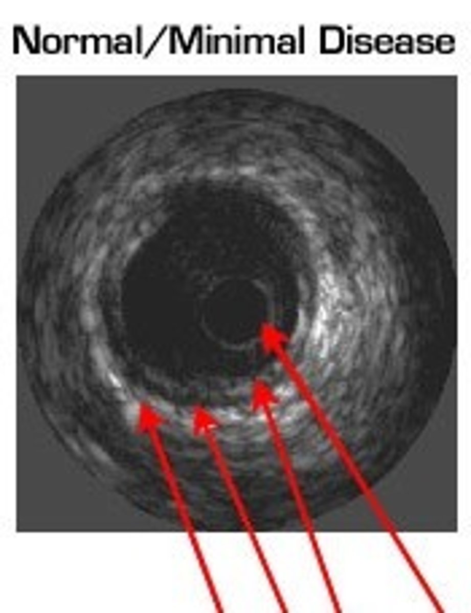 <p>adventitia, media, intima, and catheter.</p>